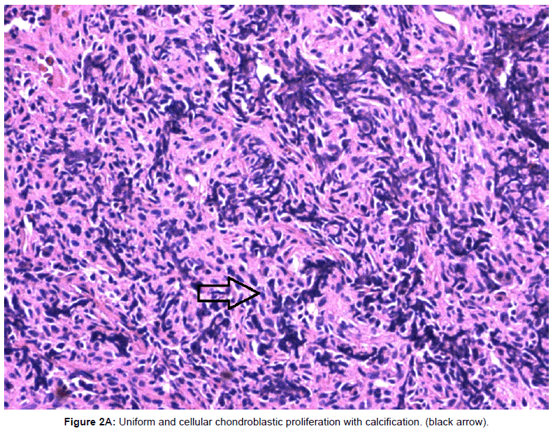 currentissue-orthopedic-oncology-cellular-chondroblastic