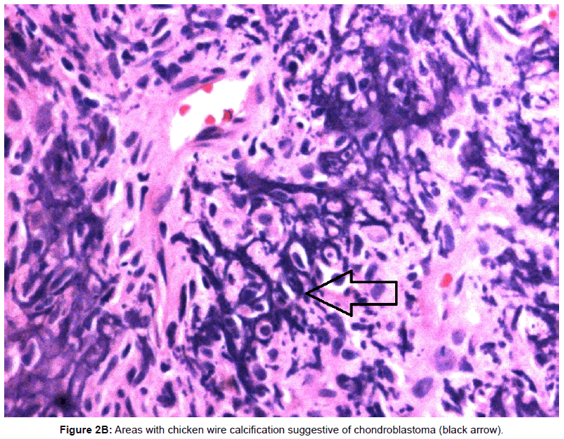currentissue-orthopedic-oncology-chondroblastoma