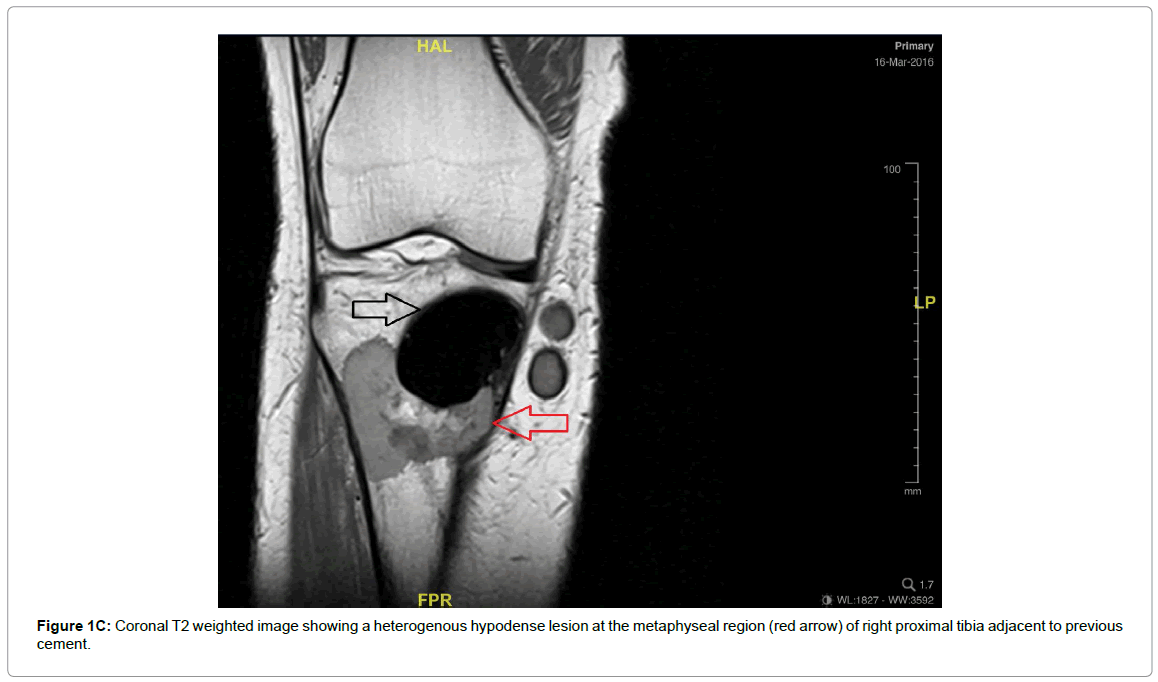 currentissue-orthopedic-oncology-heterogenous-hypodense