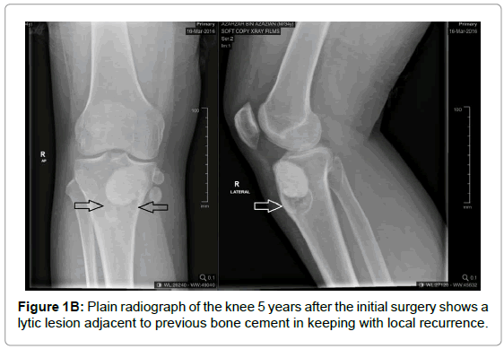 currentissue-orthopedic-oncology-lytic-lesion