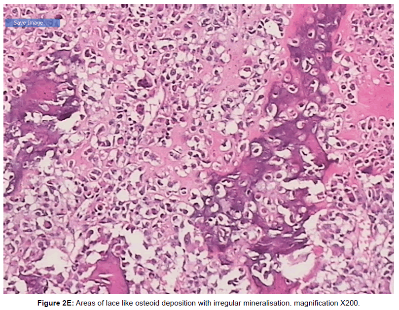 currentissue-orthopedic-oncology-mineralisation