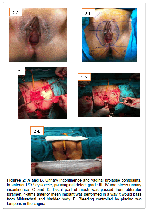 Vaginal hysterectomy resulted in hernia repair Vaginal hysterectomy resulted in hernia repair situation familiar