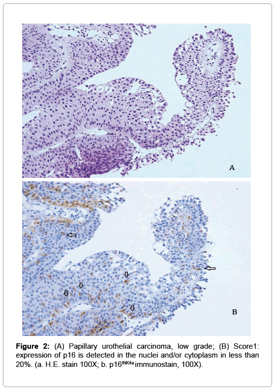cytologyhistologyurothelialcarcinoma
