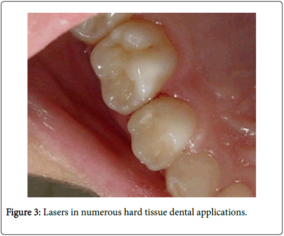 dental-implants-dentures-Lasers-numerous-hard-tissue
