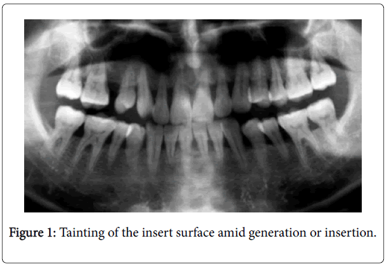 dental-implants-dentures-Tainting-insert-surface-amid