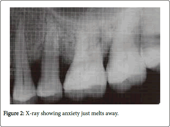 dental-implants-dentures-X-ray-showing-anxiety