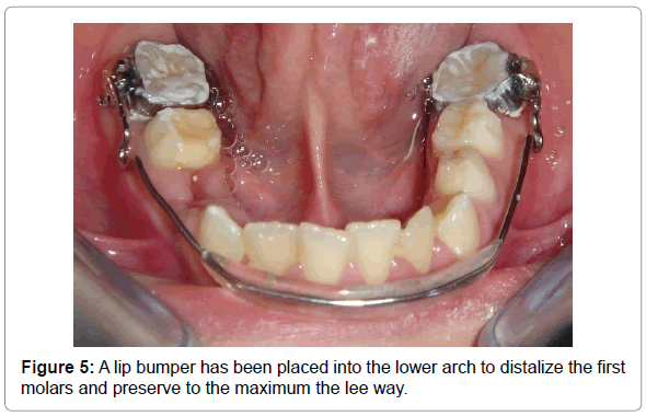 dental-implants-dentures-a-lip-bumper-placed