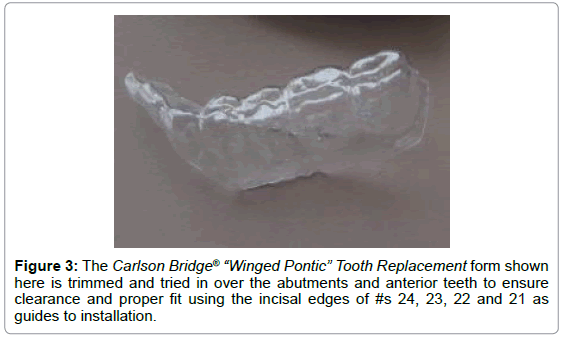 dental-implants-dentures-abutments-anterior-teeth