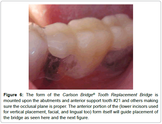 dental-implants-dentures-abutments-occlusal-incisors