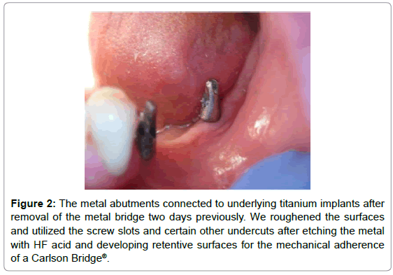 dental-implants-dentures-abutments-titanium-implants