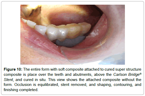 dental-implants-dentures-composite-cured-occlusion
