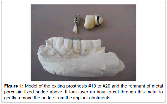 dental-implants-dentures-exiting-prosthesis-porcelain