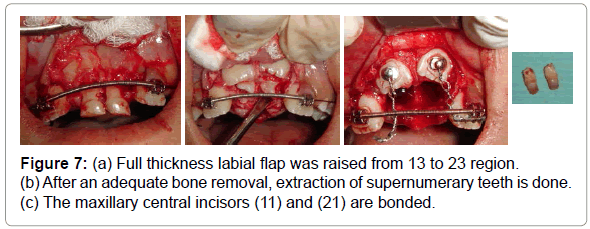 dental-implants-dentures-full-thickness-labial