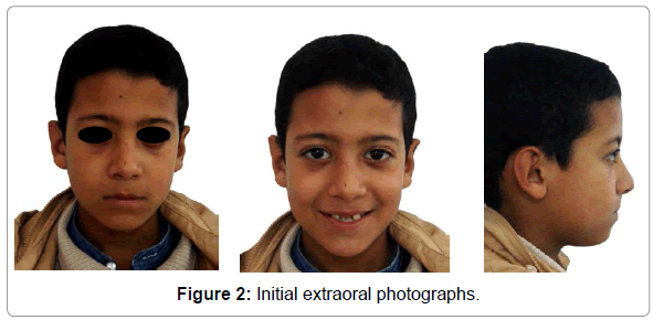 dental-implants-dentures-initial-extraoral