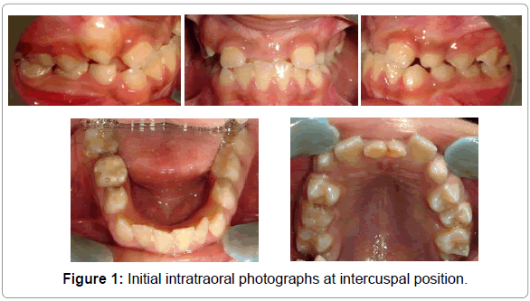 dental-implants-dentures-initial-intercuspal