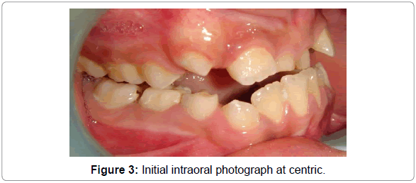 dental-implants-dentures-initial-intraoral