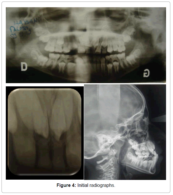 dental-implants-dentures-initial-radiographs