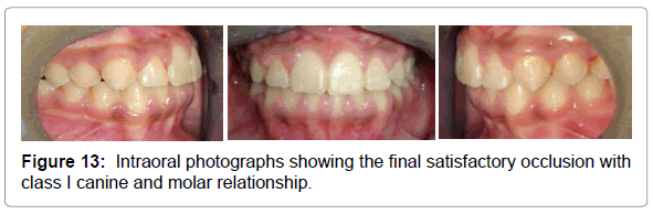 dental-implants-dentures-intraoral-photographs