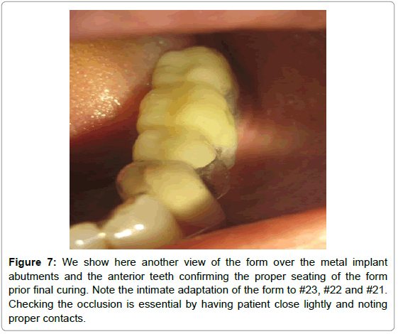 dental-implants-dentures-metal-implant-curing