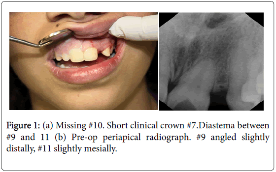 dental-implants-dentures-missing-short-clinical