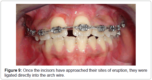 dental-implants-dentures-once-the-incisors