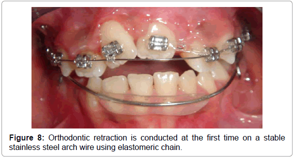 dental-implants-dentures-orthodontic-retraction