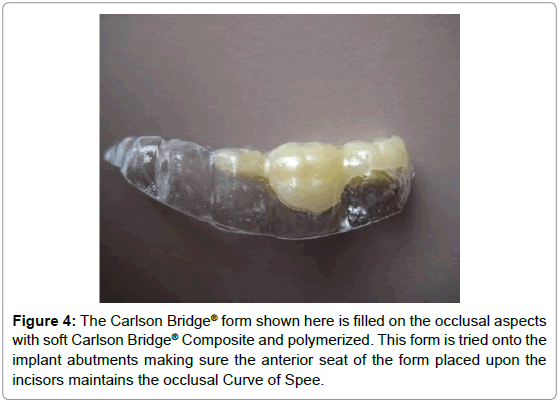dental-implants-dentures-polymerized-anterior-occlusal