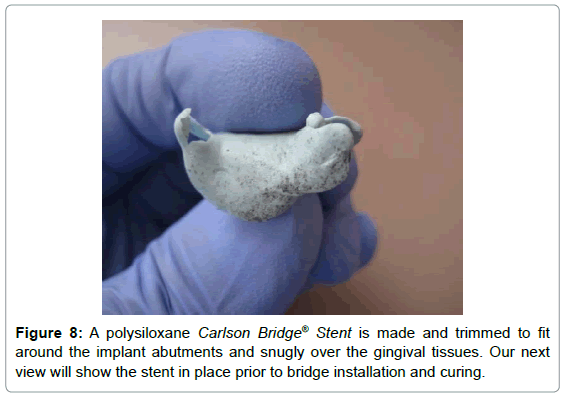 dental-implants-dentures-polysiloxane-trimmed-snugly