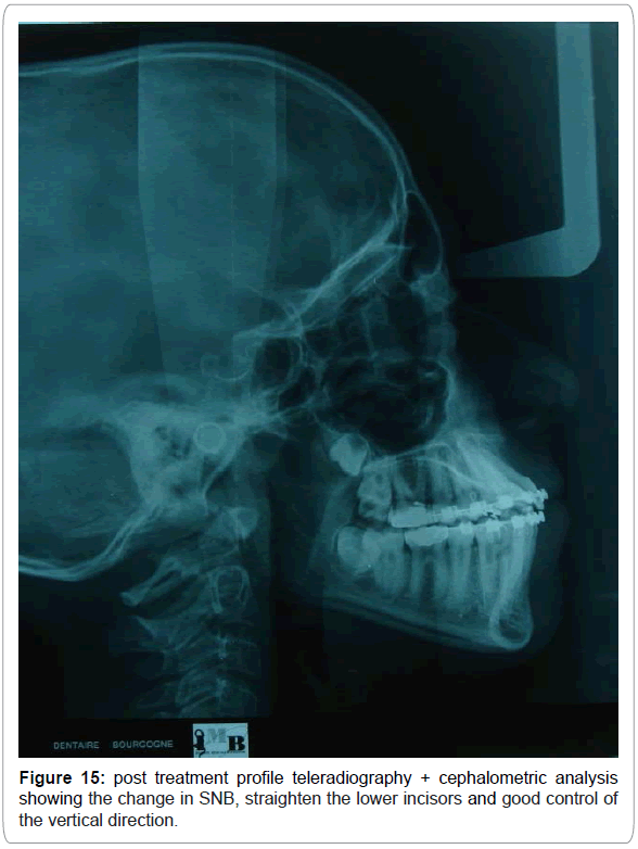 dental-implants-dentures-post-teleradiography