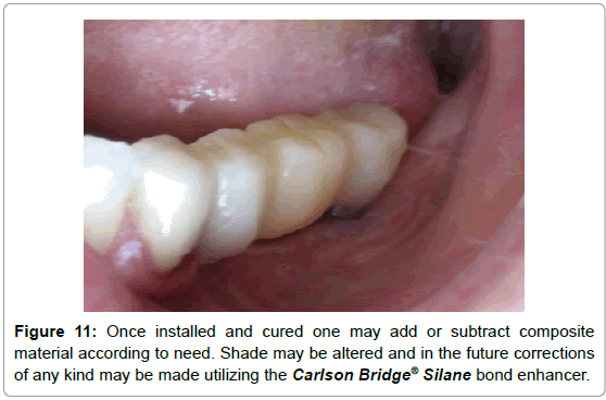 dental-implants-dentures-subtract-bond-enhancer