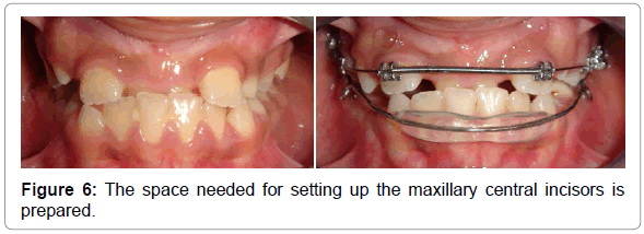 dental-implants-dentures-the-space-needed