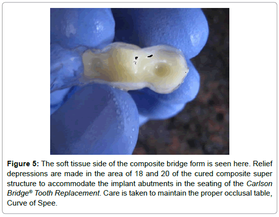 dental-implants-dentures-tissue-composite-depressions