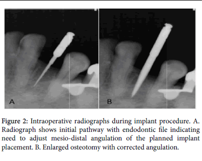 dental-implants-distal-angulation