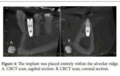 dental-implants-placed-entirely