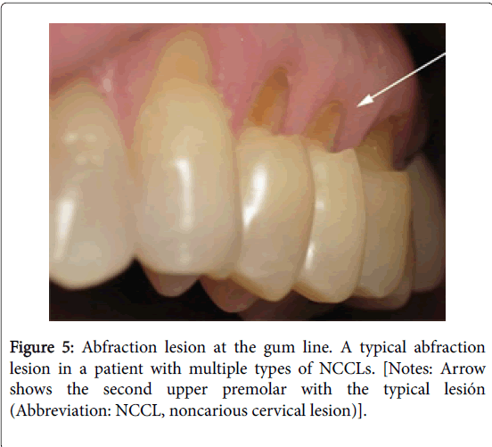 dentistryAbfractionlesion