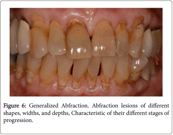 dentistry-Generalized-Abfraction