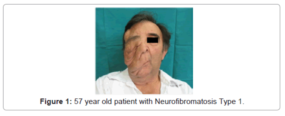 Image result for people with neurofibromatosis 1 deformities