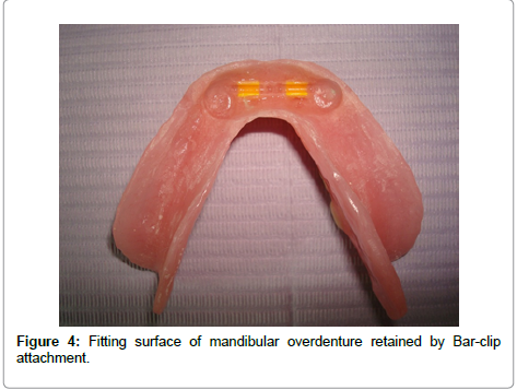overdenture