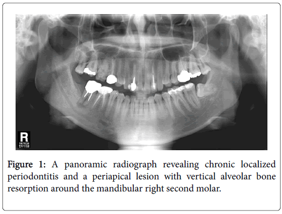 autotransplantation for the management of teeth with severe alveolar alveolar bone