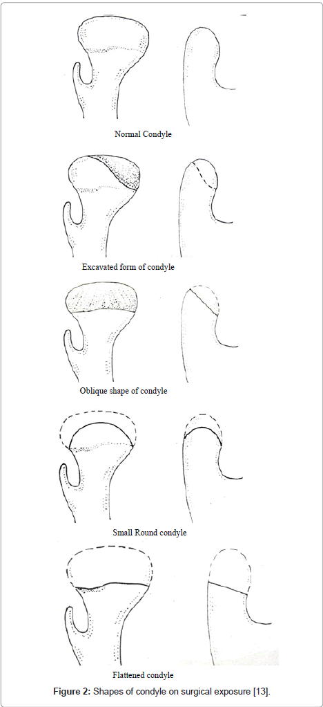 morphological and radiological variations of mandibular condyles in