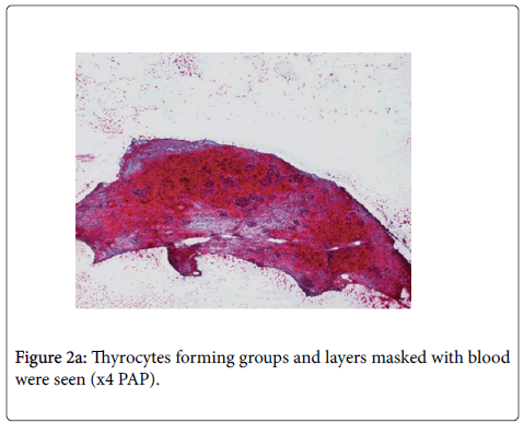 diagnostic-pathology-Thyrocytes-layers