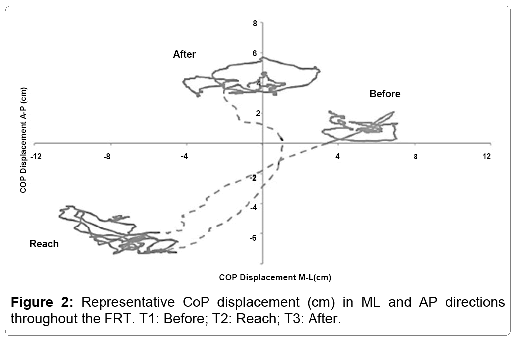 disease-parkinsonism-representative-cop-displacement-ml