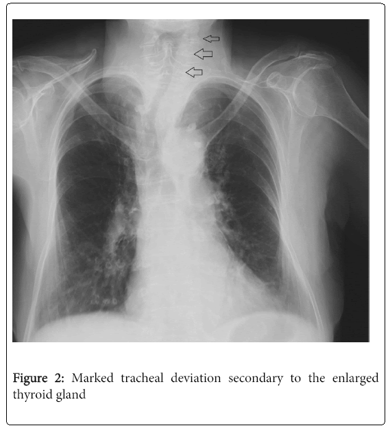 emergencymedicineMarkedtrachealdeviation