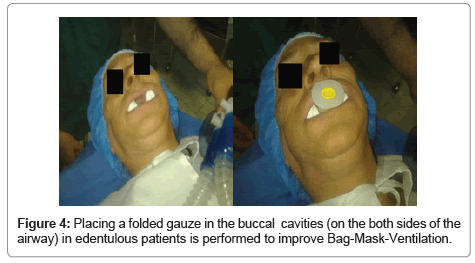 how to overcome difficult bag mask ventilation recents approaches