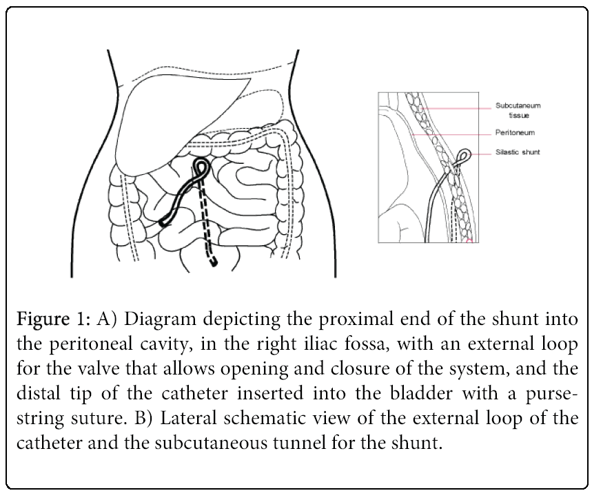 Lumbar Peritoneal Shunt Placement
