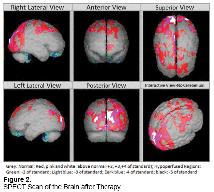 emergency-mental-health-SPECT-Scan