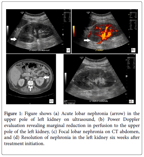 emerging-infectious-Acute-lobar-nephronia