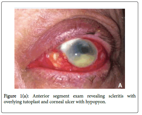 emerging-infectious-diseases-Anterior-segment