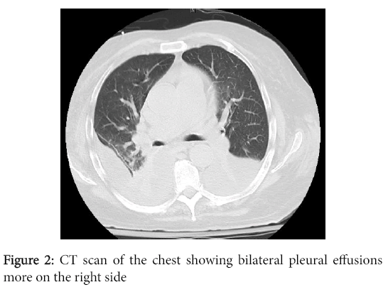 emerging-infectious-diseases-CT-scan-chest-showing-bilateral