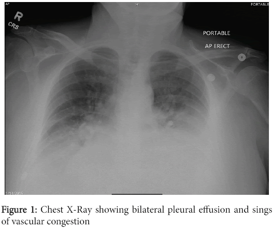 emerging-infectious-diseases-Chest-X-Ray-showing-bilateral